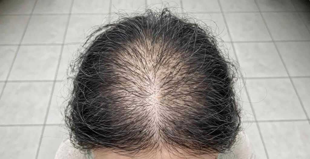 L'immagine illustra un caso di alopecia androgenetica femminile, con il tipico diradamento che si osserva nella donna